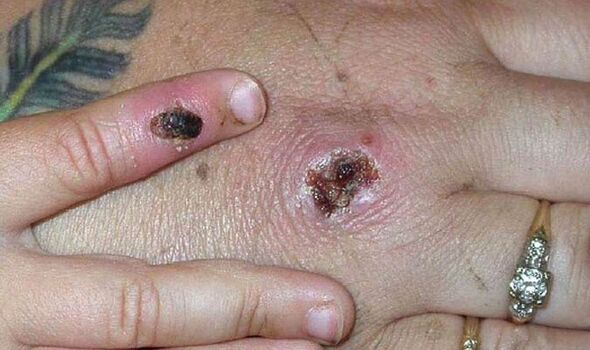 Monkeypox outbreak: Huge surge in cases linked to gay 'sauna' in Spain